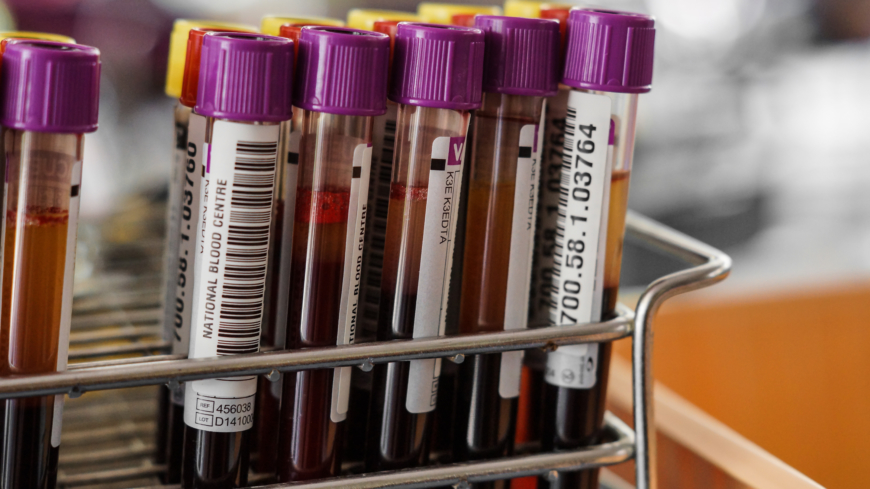 Polycytemia vera upptäcks ibland av en slump när man tar blodprov av andra anledningar. Typiskt är ett ökat antal röda blodkroppar. Foto: Shutterstock